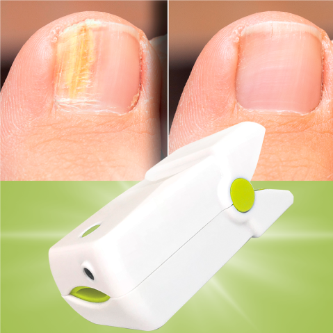 Toenail Fungus Remover