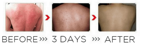 Eczema Cream - Eczema Lotion - Best Eczema Cream