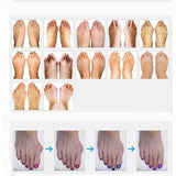 Bunion Corrector - Orthopedic Bunion Corrector