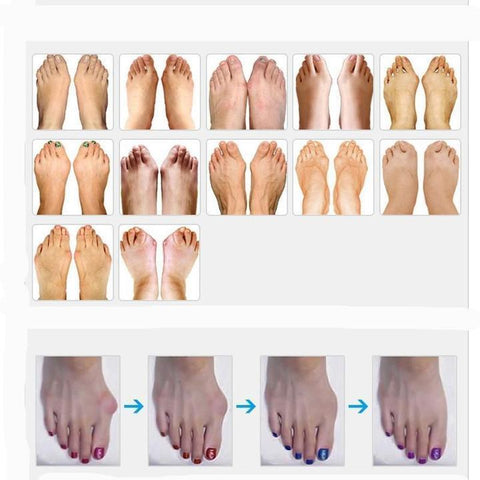 Bunion Corrector - Orthopedic Bunion Corrector
