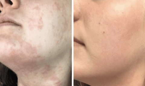 Eczema Cream - Eczema Lotion - Best Eczema Cream