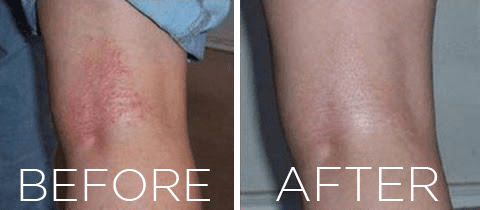 Eczema Cream - Eczema Lotion - Best Eczema Cream