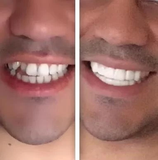 Fake Teeth - Snap-On Smile - Fake Teeth Veneers