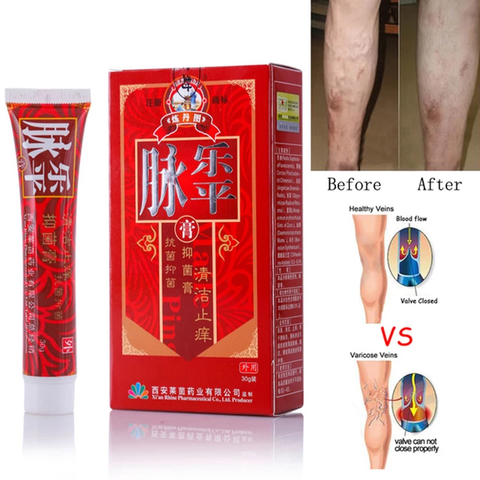 Varicose Veins Cream - Varicose Veins Treatment Cream