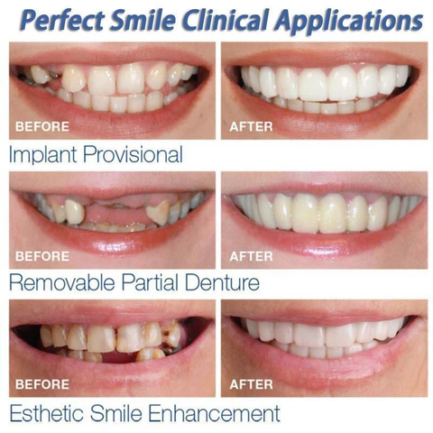 Fake Teeth - Snap-On Smile - Fake Teeth Veneers